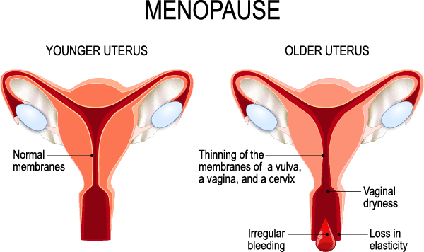 Menopause - Christian Counselors of Mooresville During perimenopause, there is thinning of the. membranes of the vulva, vagina, and cervix, irregular bleeding, vaginal. dryness, and loss in elasticity.